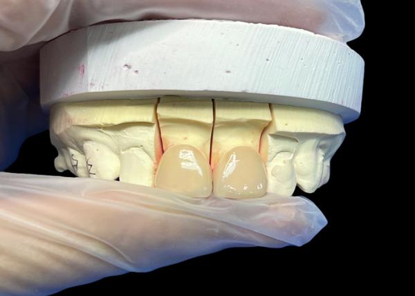 Precision Strength EMAX Porcelain Veneer incisor for Natural looking Aesthetic
