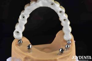 Wholesale High Strength Ti-Base Hybrid Zirconia Bridge Fracture Resistance Dental Solution from china suppliers