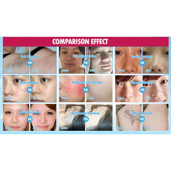 New Arrival Beauty Machine Laser Permanent Fast Hair Removal (MJ402)
