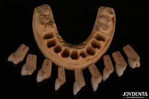 Wholesale Precise Fit Dental Feldspathic Veneer Highly Natural With Glossy Surface Texture from china suppliers