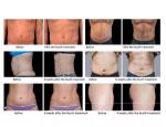Rf Odm Ems Body Sculpting Machine Abs Stainless Steel