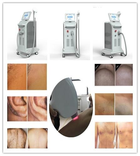 2019 newest Painless 808 1064 755 triple wavelength hair removal large spot size