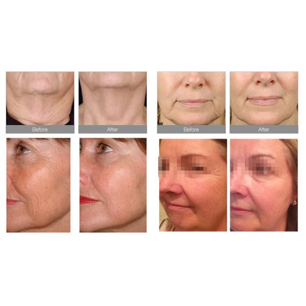 Clinical Use High Intensity Focused Ultrasound Machine Skin Elasticity Improving