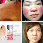 spider vein laser machine cost