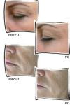 Beauty Equipment Hot Sale Fractional Rf Microneedle Skin Solution Beauty Tighten