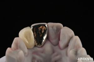 Wholesale Metallic Dental Maryland Bridge Good Chewing Function For Long Lasting Remediation from china suppliers