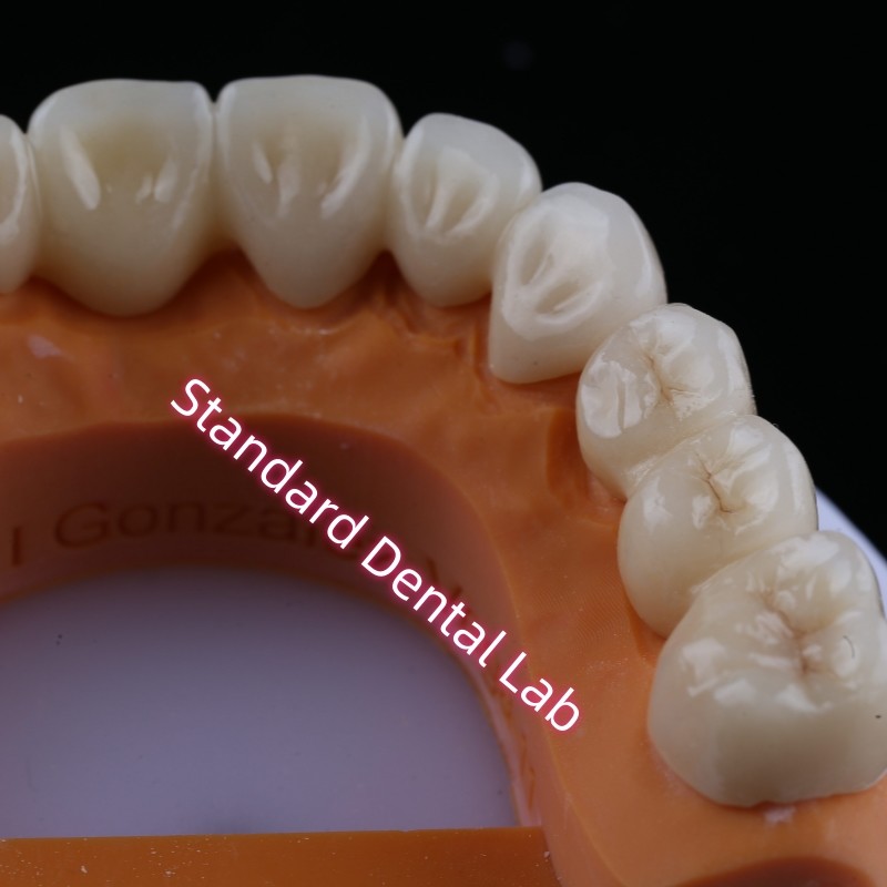 Digital CAD CAM Milling Layered Zirconia Bridge Crown With Pink Porcelain