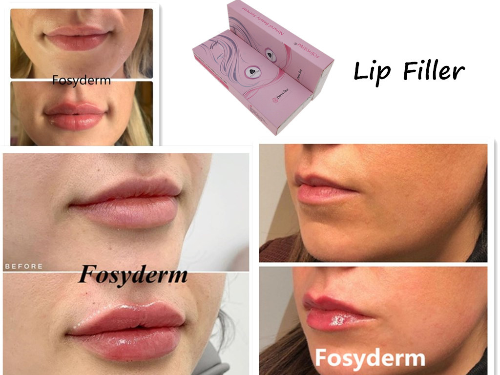 Transparent Fosyderm Lips Hyaluronic Acid Chin Filler 24mg Sodium Hyaluronate