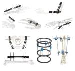 Orthopedic Surgery Pelvic External Fixator Two Section Type