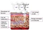 Top selling newest best hot ultras hifu slimming factory price ultrasound hifu