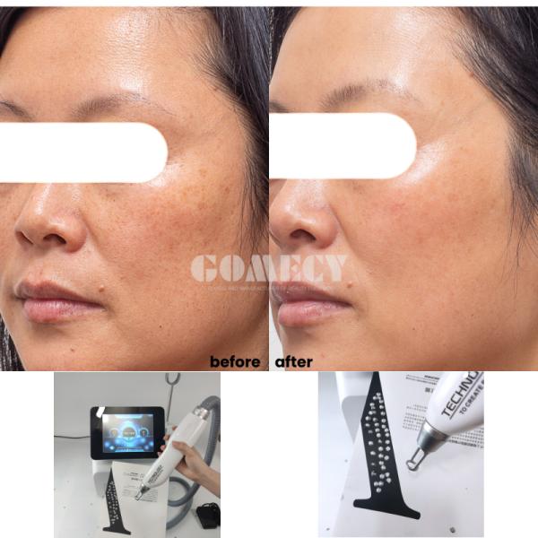 High Power ND:YAG Laser, Solid State Laser Device, Tattoo Removal Machine, Birthmark Removal Laser, Pigment Treatment Equipment, Carbon Peeling Laser System, Pore Shrinking Device, Eyebrow Cleaning Laser, Multi Wavelength Laser Machine, Adjustable Frequency Laser