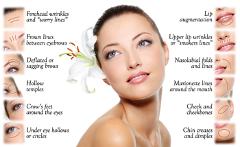 Hialuronato De Sodio Gel Volume Hyaluronic Dermal Filler For Lip Injections