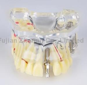 Wholesale dental caries dental bridge dental teaching communication oral implant nail demonstration model from china suppliers