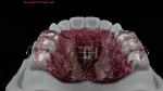 Teeth Expansion And Distalization Adjusting Expander In Mouth Orthodontist