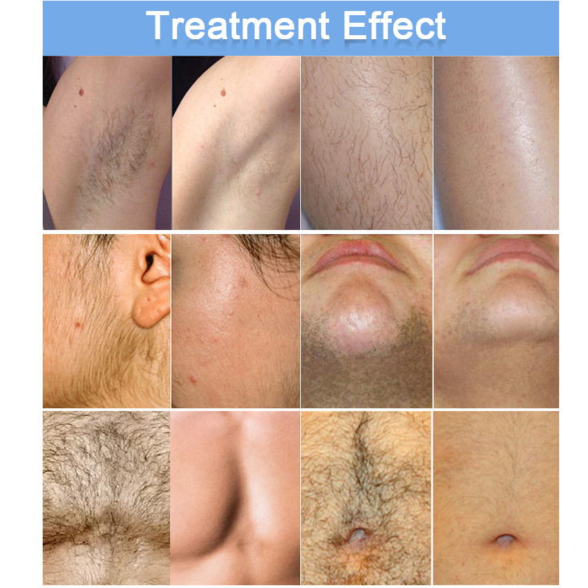 Diode Laser Hair Removal Machine Quickest And Painless Permanent Hair Removal