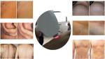808nm Diode Laser Hair Removal Machine Permanent For Men Or Women