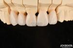 Highly Customizable Layered Zirconia Dental Crowns And Bridges Long Lasting