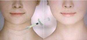 Wholesale Achieve Plumper Lips With Dermal Lip Fillers Neck Lines Filling Face Wrinkles Filler from china suppliers
