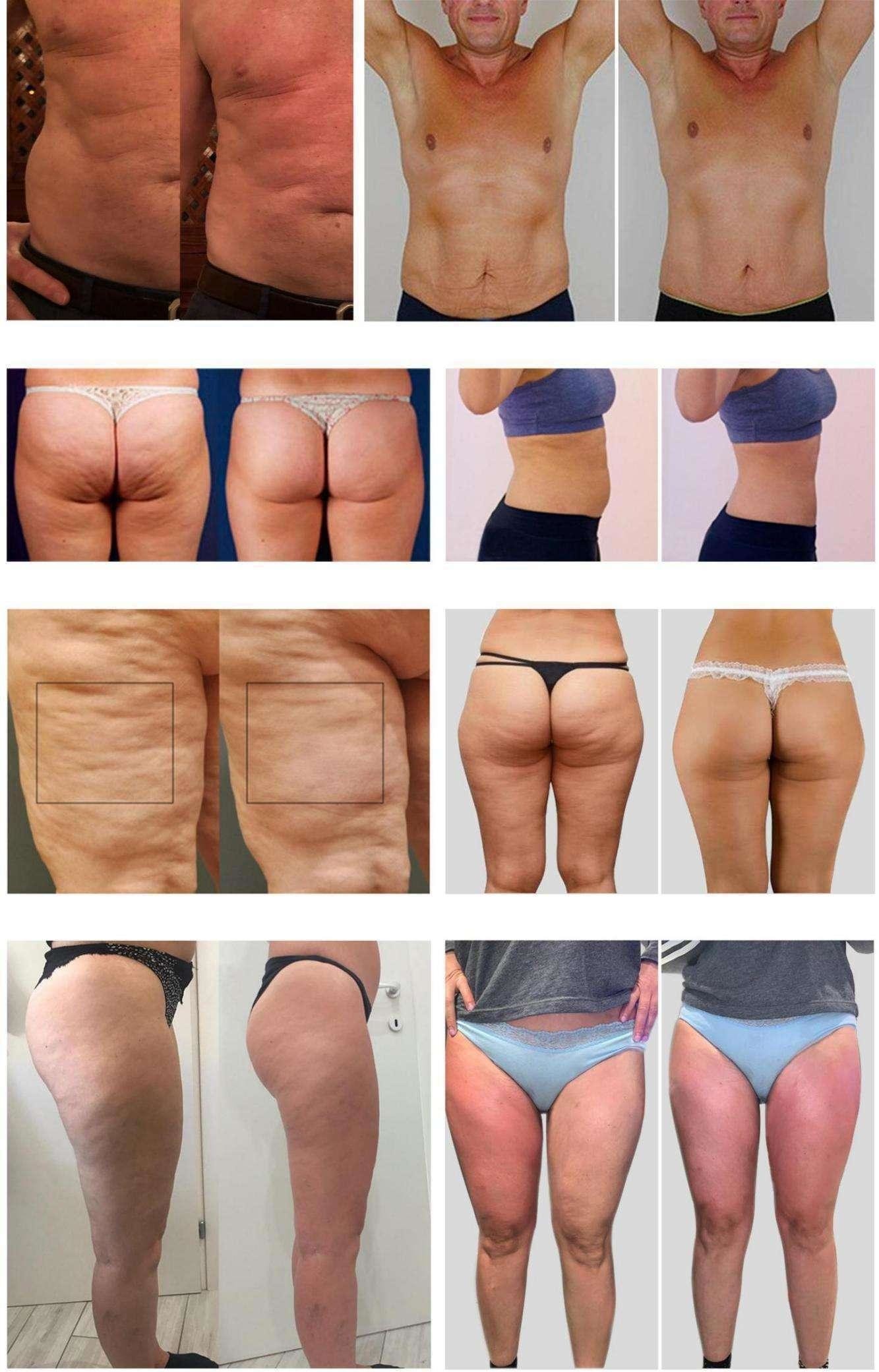 All In One 10D Slimming Roller Laser Equipment With Biolight Technology For Clinics And Spas