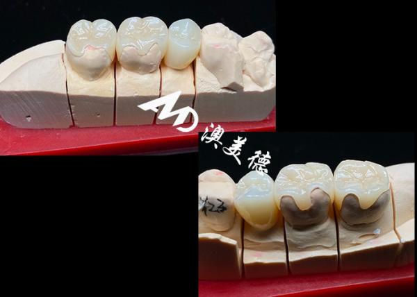 OEM Precision Fit Ceramic Inlays Onlays for Durable and Natural-Looking Dental
