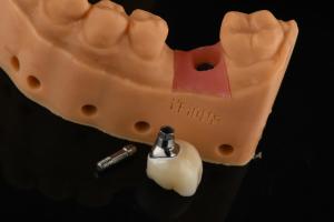 Wholesale Precision Cylindrical Silver Single Tooth Replacement Implants Dental Restoration from china suppliers