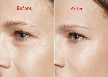 2ml HA Injectable Dermal Filler For Fine Wrinkles