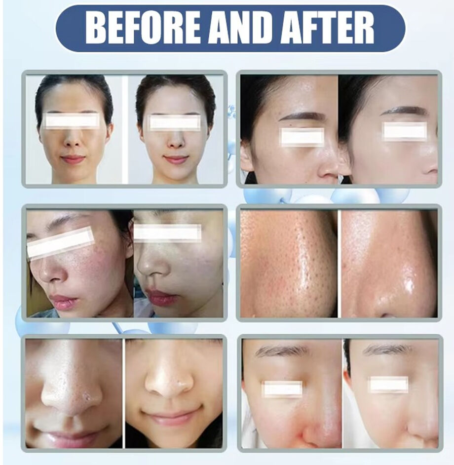 Best Care Facial Home Microdermabrasion Machine 2024 Beauty Equipment