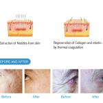 Gold RF Microneedle-Machine Vertical Fractional RF Microneedle Face and Body