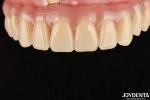 Fast Drying 5 Minutes Acrylic Teeth Finish For Dental Tooth Restoration