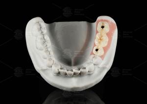 Wholesale Screw Retained Titanium Custom Abutment Porcelain Fused To Zirconia from china suppliers