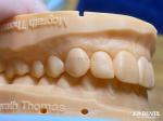High Permeability Natural Looking Veneers Porcelain Veneers Emax Customized