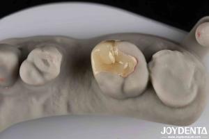Wholesale Strong Resistance To Fracture Emax Inlay Onlay Natural-looking Esthetics And Durability from china suppliers