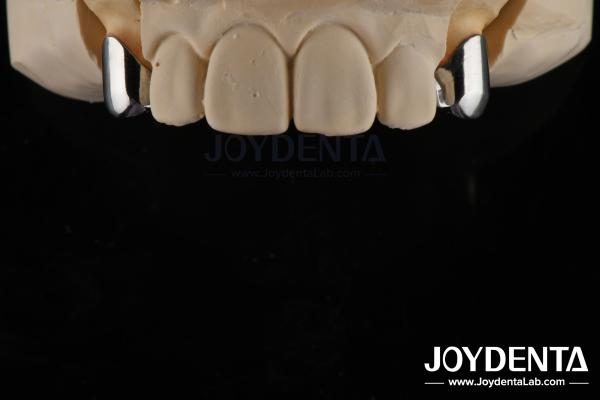 Precision Removable Prosthesis Dental Implant Attachments Easy Clean Comfortable