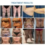 40K Cavitation 360 Cryolipolysis Machine 7 In 1 For Body Slimming Beauty Device