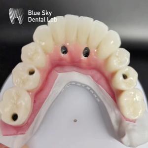 Wholesale Full Arch Dental Implant Cases Compatible With Multiple Implant Systems from china suppliers