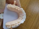 Natural Esthetics Layered Zirconia Crown Bridge For Beautiful Smile And Good