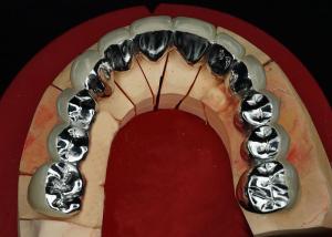 Wholesale Highly Durable Restoration Porcelain Fused To Metal Crown For Natural Looking Smile from china suppliers