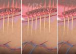 3.5 Mm Depth 5mhz Fractional Rf Microneedle Machine