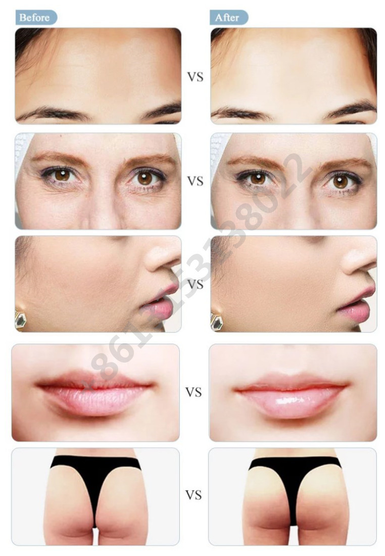 1ml Cross Linked Hyaluronic Acid Dermal Filler Injection Deep For Nose Chin Cheek