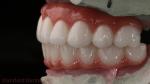 High Quality Dental zirconia crown and All On Four Six Implant Full Arch / China