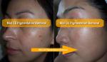 Double Wavelength Pico Laser Machine 1064 Nm 532 Nm ND YAG Laser Machine For Age