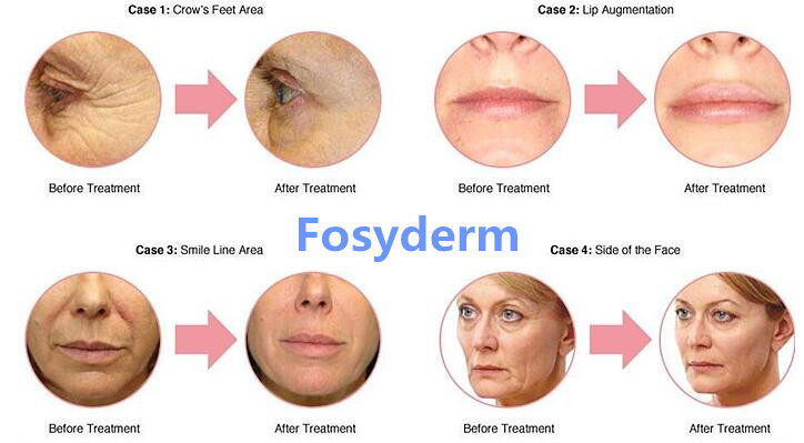 Skin Care Hyaluronic Acid Injectable Dermal Filler for Anti Wrinkle 2ml CE ISO