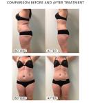 1600w 5 Handles Cryolipolysis Slimming Machine 360 Degree Cryo Shape Machine