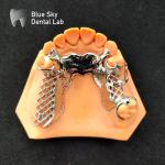 Skelete Chrome Metal Partial Denture Printed CoCr Denture Design
