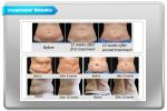 2016 hottest !!! cryolipolysis slimming machine, 3 cooling system, fat freezing