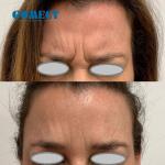 PE-Face Facial Muscle Stimulation mfface High Intensity Electromagnetic EMS