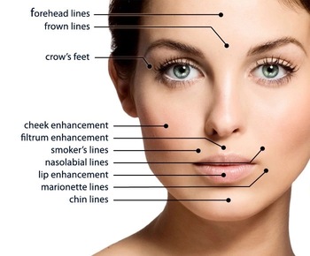 Transparent Fosyderm Lips Hyaluronic Acid Chin Filler 24mg Sodium Hyaluronate