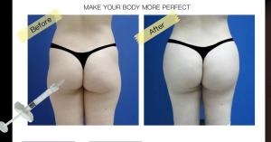 Wholesale Subskin SubQ Injectable Hyaluronic Acid Breast Filler For Buttock Penis Augmentation from china suppliers