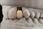 Long-Lasting Implant Crown And Bridge For Restoring Missing Teeth Suitable For