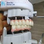 Layered Zirconia Implant Customization Full Arch Implant Cases